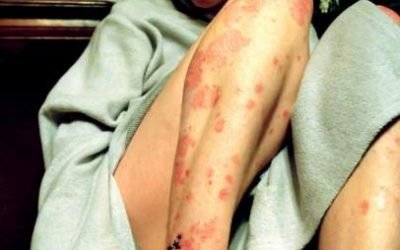 La vida de quienes sufren dermatitis atópica grave cambiará en dos meses “de forma radical”